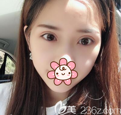 李烈帕克法雙眼皮術(shù)后2個(gè)月恢復(fù)照 李烈帕克法雙眼皮術(shù)后2個(gè)月恢復(fù)照