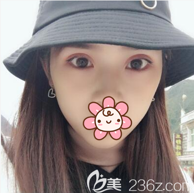 終于找醫(yī)院李烈做了帕克雙眼皮，分享一些我做手術(shù)的實際感受給求美的朋友們