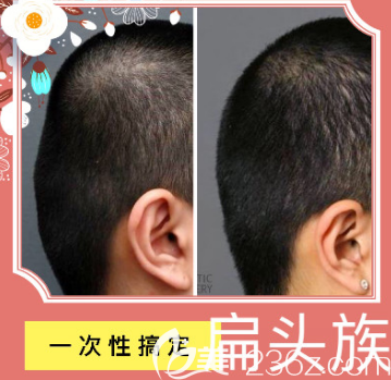 韓國(guó)愛(ài)婷男士后腦勺骨水泥填充案例效果對(duì)比圖