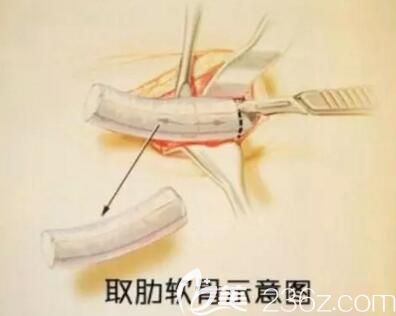 取自體肋軟骨示意圖