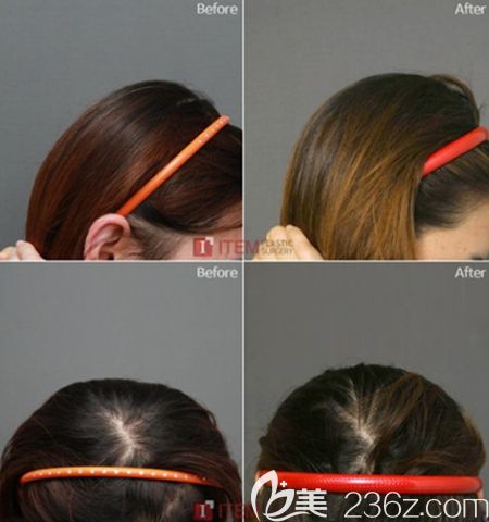 韓國(guó)愛(ài)婷后腦勺填充手術(shù)案例