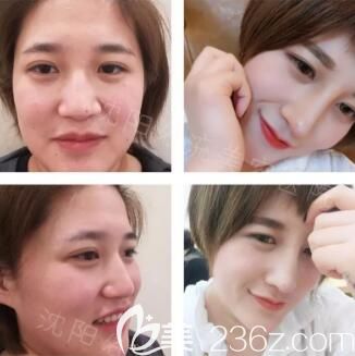 沈陽名流肋軟骨隆鼻真人前后效果對(duì)比