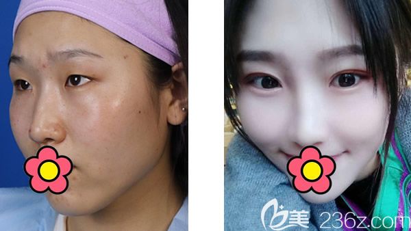 呼和浩特京美朱京成全切雙眼皮+駝峰鼻矯正案例 呼和浩特京美朱京成全切雙眼皮+駝峰鼻矯正案例