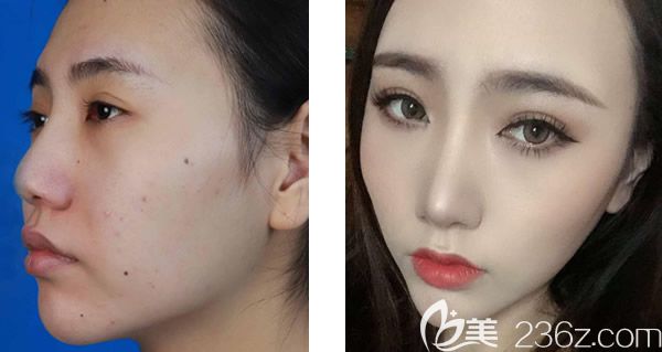 呼和浩特京美朱京成鼻綜合隆鼻+硅膠假體墊下巴案例 呼和浩特京美朱京成鼻綜合隆鼻+硅膠假體墊下巴案例