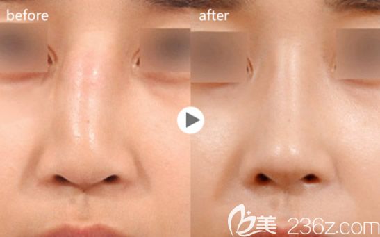 呼和浩特京美劉野醫(yī)生SAP多維鼻整形失敗修復(fù)案例 呼和浩特京美劉野醫(yī)生SAP多維鼻整形失敗修復(fù)案例