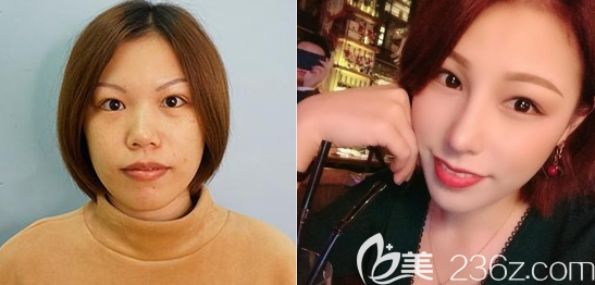 佛山曙光金子宋仁剛做的隆鼻案例