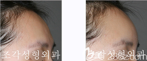 額頭不飽滿的側(cè)面照與骨水泥填充整形后效果對(duì)比