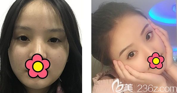 呼和浩特京美王巖主任全切雙眼皮+全臉脂肪填充+激光祛斑前后效果對比案例 呼和浩特京美王巖主任全切雙眼皮+全臉脂肪填充+激光祛斑前后效果對比案例