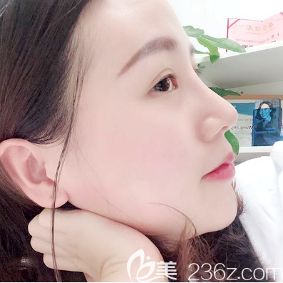 佛山曙光金子宋仁剛隆鼻案例20天自拍 佛山曙光金子宋仁剛隆鼻案例20天自拍