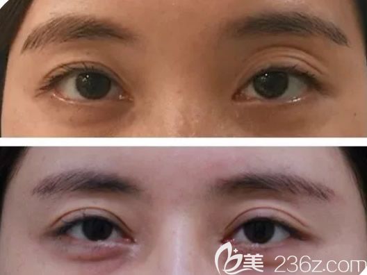 呼和浩特京美馬曉艷雙眼皮修復(fù)案例 呼和浩特京美馬曉艷雙眼皮修復(fù)案例