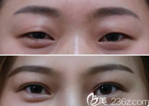 呼市京美馬曉艷切開重瞼+內(nèi)切去眼袋3個月前后效果對比 呼市京美馬曉艷切開重瞼+內(nèi)切去眼袋3個月前后效果對比