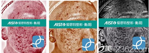 氐殊治療前VISIA儀器檢測分析 氐殊治療前VISIA儀器檢測分析