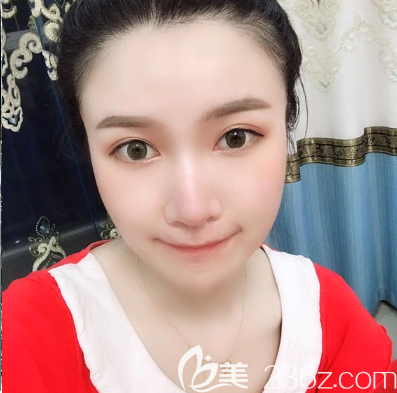 佛山曙光金子李淑薇雙眼皮案例一個(gè)月自拍 佛山曙光金子李淑薇雙眼皮案例一個(gè)月自拍