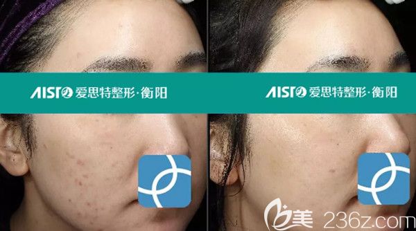 氐殊治療前后效果圖 氐殊治療前后效果圖