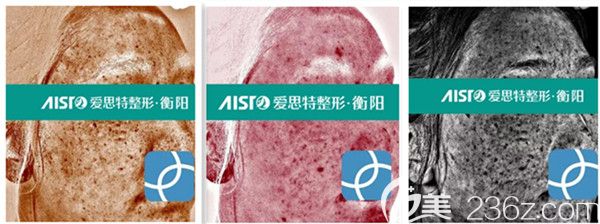 氐殊治療后VISIA儀器檢測分析 氐殊治療后VISIA儀器檢測分析