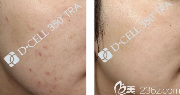 痘痘臉親身體驗(yàn)的氐殊，四個療程后來曬圖