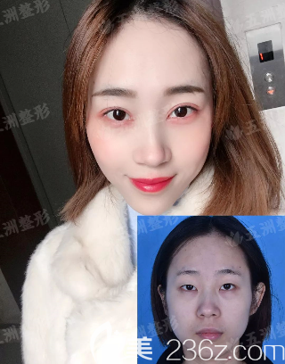 重慶五洲整形雙眼皮怎么樣