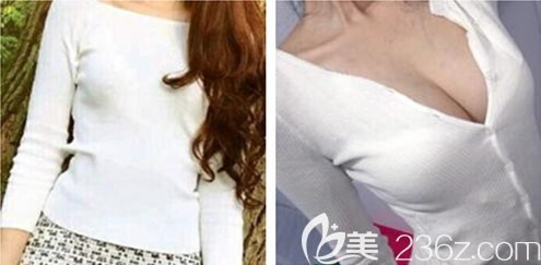 重慶五洲整形豐胸案例