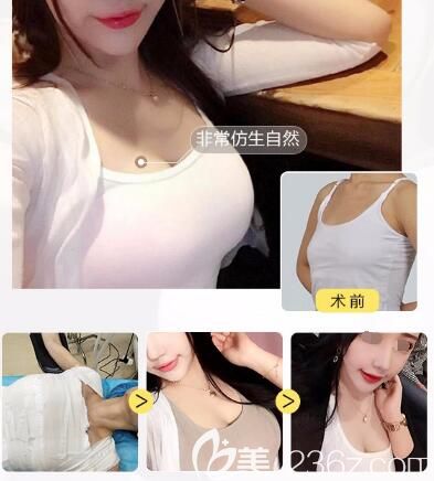 到常州美貝爾做隆胸前后對(duì)比案例
