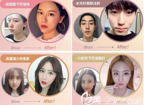 韓國繆慈微整形案例展示