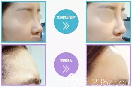 韓國清潭珠顏玻尿酸注射案例