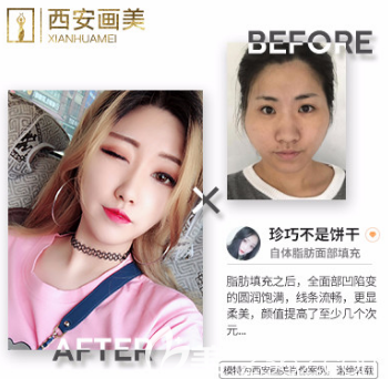 張新成整形外科主任醫(yī)生自體脂肪填充案例