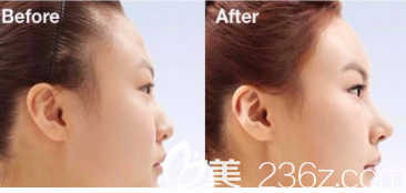 許順龍醫(yī)生自體脂肪填充面部案例