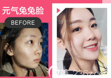 張林宏醫(yī)生自體脂肪填充面部案例