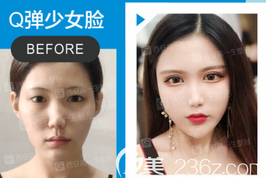 張林宏醫(yī)生自體脂肪填充面部案例2