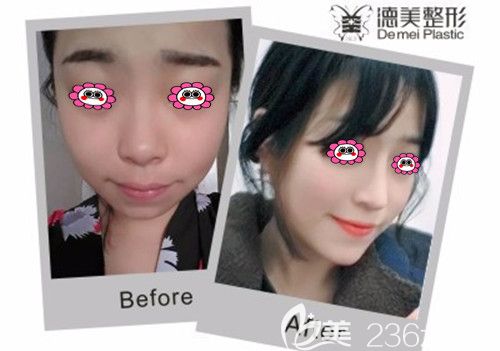 鼻綜合前后效果圖 鼻綜合前后效果圖