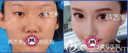 佳木斯韓藝來雙眼皮案例