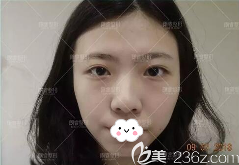 雙眼皮面部填充術前照片 雙眼皮面部填充術前照片