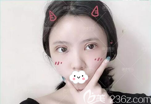 雙眼皮面部填充術后5天 雙眼皮面部填充術后5天