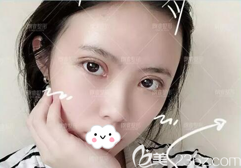 切開雙眼皮+脂肪面填10天恢復效果 切開雙眼皮+脂肪面填10天恢復效果