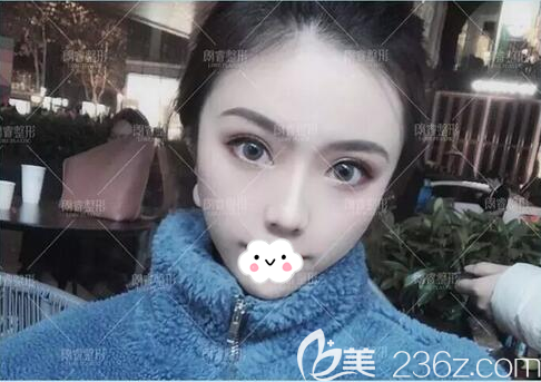 半年前我在做了雙眼皮和SVF脂肪膠填充面部，我覺得應(yīng)該分享下自己的恢復(fù)圖片