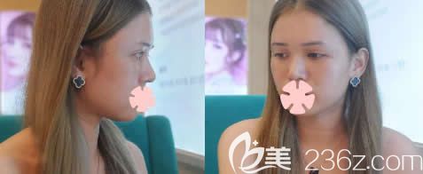 自體脂肪填充全臉很假嗎？桂林美麗焦點(diǎn)整形全臉自體脂肪填充真人案例來揭曉