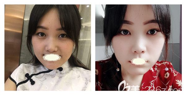 武漢壹加壹王政祥醫(yī)生瘦臉除皺瘦臉+祛眼袋真實(shí)術(shù)后案例圖展示 武漢壹加壹王政祥醫(yī)生瘦臉除皺瘦臉+祛眼袋真實(shí)術(shù)后案例圖展示