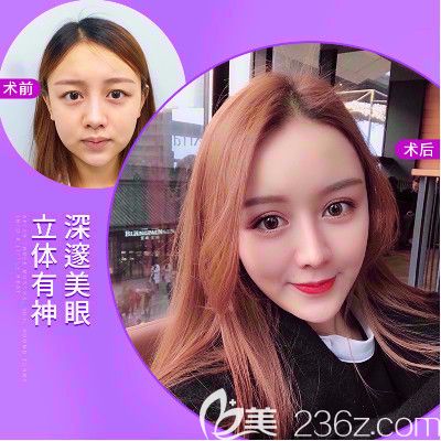 普寧安琪整形醫(yī)院雙眼皮案例 普寧安琪整形醫(yī)院雙眼皮案例