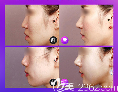 普寧安琪醫(yī)院醫(yī)療美容科隆鼻案例 普寧安琪醫(yī)院醫(yī)療美容科隆鼻案例