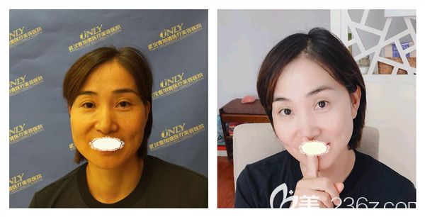 武漢壹加壹王政祥醫(yī)生面部線(xiàn)雕術(shù)后10天案例對(duì)比圖 武漢壹加壹王政祥醫(yī)生面部線(xiàn)雕術(shù)后10天案例對(duì)比圖