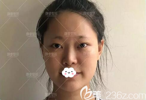 照房志強做鼻修復(fù)的術(shù)前照 照房志強做鼻修復(fù)的術(shù)前照