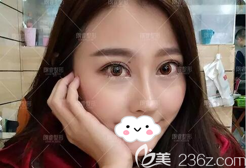 隆鼻+面部脂肪填充術(shù)后20天 隆鼻+面部脂肪填充術(shù)后20天