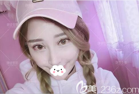 房志強半肋軟骨隆鼻修復(fù)術(shù)后一個月 房志強半肋軟骨隆鼻修復(fù)術(shù)后一個月