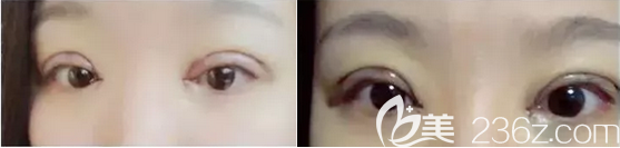 楊林雙眼皮開眼角術(shù)后即刻 楊林雙眼皮開眼角術(shù)后即刻