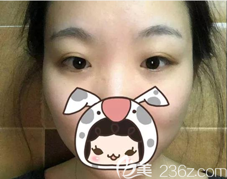 雙眼皮開眼角術(shù)前照片 雙眼皮開眼角術(shù)前照片
