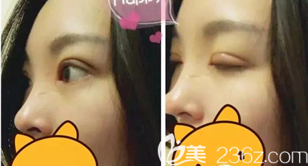 切開雙眼皮術(shù)后10天恢復(fù)效果 切開雙眼皮術(shù)后10天恢復(fù)效果