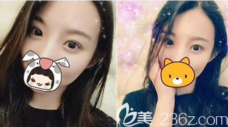  大家看看我在廣元美華整形美容醫(yī)院找楊林做這雙眼皮效果，花8000值不值