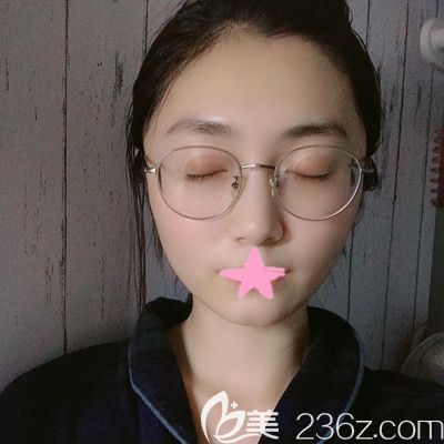 武漢壹加壹王政祥主任面部線雕提升術(shù)后4天效果圖 武漢壹加壹王政祥主任面部線雕提升術(shù)后4天效果圖