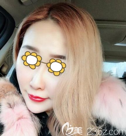 面部埋線提升術(shù)后30天效果