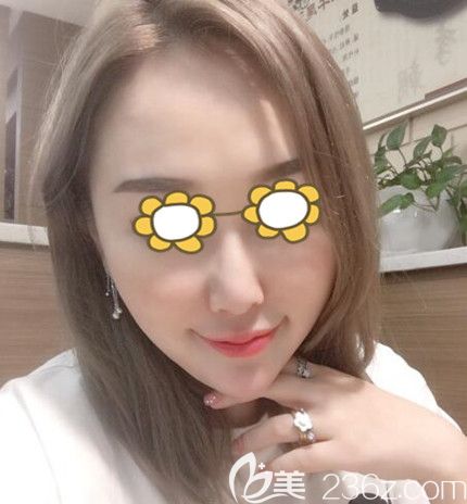 面部埋線提升術(shù)后60天效果